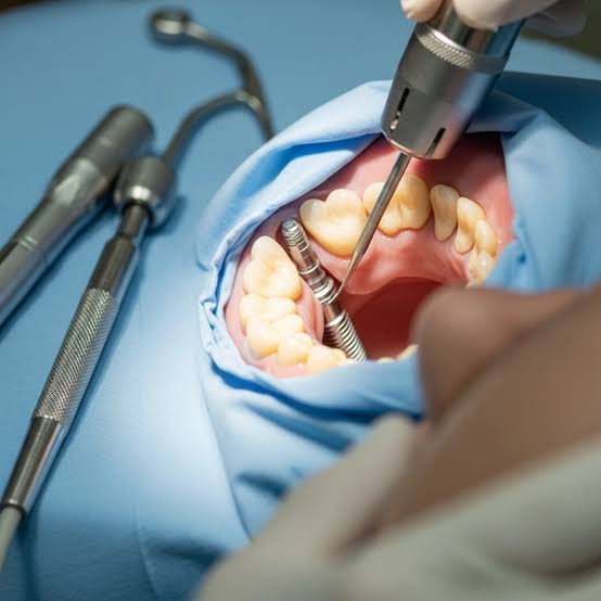 Dental Implant
